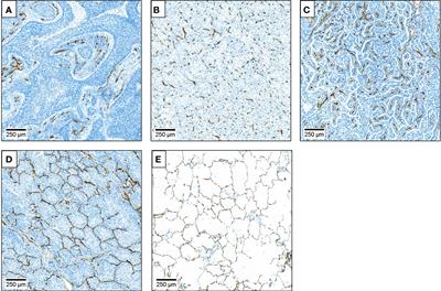 Impact of microvessel patterns and immune status in NSCLC: a non-angiogenic vasculature is an independent negative prognostic factor in lung adenocarcinoma